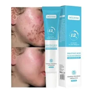 MOOYAM Salicylic Acid Acne Removal Gel Buy 1 Get 1 FREE
